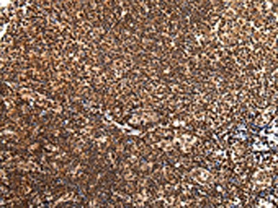 The image on the left is immunohistochemistry of paraffin-embedded Human tonsil tissue using CSB-PA077831(ZNF200 Antibody) at dilution 1/30, on the right is treated with synthetic peptide. (Original magnification: ×200)