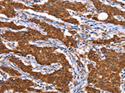 The image on the left is immunohistochemistry of paraffin-embedded Human gastic cancer tissue using CSB-PA077840(RPS6KA6 Antibody) at dilution 1/20, on the right is treated with synthetic peptide. (Original magnification: ×200)