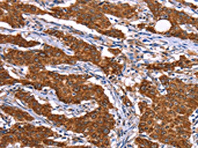 The image on the left is immunohistochemistry of paraffin-embedded Human gastic cancer tissue using CSB-PA077840(RPS6KA6 Antibody) at dilution 1/20, on the right is treated with synthetic peptide. (Original magnification: ×200)