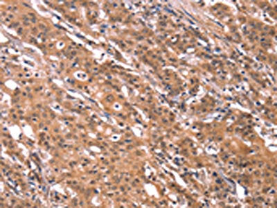 The image on the left is immunohistochemistry of paraffin-embedded Human gastic cancer tissue using CSB-PA077924(FGF22 Antibody) at dilution 1/20, on the right is treated with synthetic peptide. (Original magnification: ×200)
