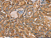 The image on the left is immunohistochemistry of paraffin-embedded Human thyroid cancer tissue using CSB-PA077979(PLS3 Antibody) at dilution 1/30, on the right is treated with fusion protein. (Original magnification: ×200)
