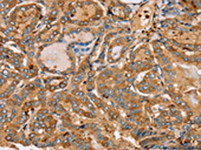 The image on the left is immunohistochemistry of paraffin-embedded Human thyroid cancer tissue using CSB-PA077979(PLS3 Antibody) at dilution 1/30, on the right is treated with fusion protein. (Original magnification: ×200)