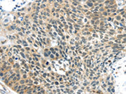 The image on the left is immunohistochemistry of paraffin-embedded Human esophagus cancer tissue using CSB-PA078085(TSPY1 Antibody) at dilution 1/40, on the right is treated with synthetic peptide. (Original magnification: ×200)