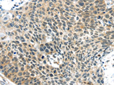 The image on the left is immunohistochemistry of paraffin-embedded Human esophagus cancer tissue using CSB-PA078085(TSPY1 Antibody) at dilution 1/40, on the right is treated with synthetic peptide. (Original magnification: ×200)