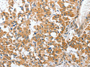 The image on the left is immunohistochemistry of paraffin-embedded Human thyroid cancer tissue using CSB-PA078194(CHMP4B Antibody) at dilution 1/40, on the right is treated with fusion protein. (Original magnification: ×200)