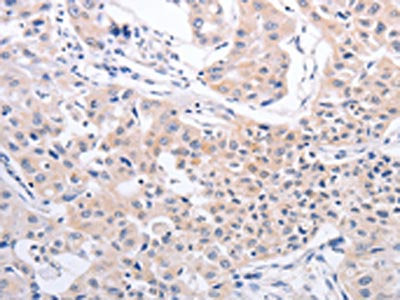 The image on the left is immunohistochemistry of paraffin-embedded Human lung cancer tissue using CSB-PA078303(PFN4 Antibody) at dilution 1/20, on the right is treated with fusion protein. (Original magnification: ×200)