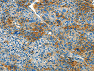 The image on the left is immunohistochemistry of paraffin-embedded Human liver cancer tissue using CSB-PA078460(L1CAM Antibody) at dilution 1/40, on the right is treated with synthetic peptide. (Original magnification: ×200)
