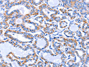 The image on the left is immunohistochemistry of paraffin-embedded Human thyroid cancer tissue using CSB-PA078489(GJB3 Antibody) at dilution 1/30, on the right is treated with fusion protein. (Original magnification: ×200)