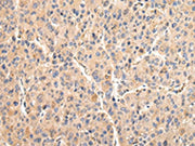 The image on the left is immunohistochemistry of paraffin-embedded Human liver cancer tissue using CSB-PA078497(VCAM1 Antibody) at dilution 1/30, on the right is treated with fusion protein. (Original magnification: ×200)