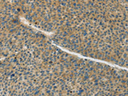 The image on the left is immunohistochemistry of paraffin-embedded Human liver cancer tissue using CSB-PA078531(GJC1 Antibody) at dilution 1/50, on the right is treated with synthetic peptide. (Original magnification: ×200)