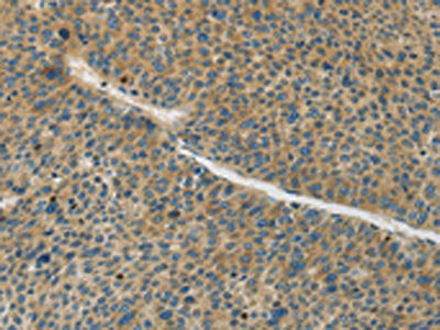The image on the left is immunohistochemistry of paraffin-embedded Human liver cancer tissue using CSB-PA078531(GJC1 Antibody) at dilution 1/50, on the right is treated with synthetic peptide. (Original magnification: ×200)