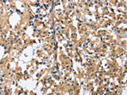 The image on the left is immunohistochemistry of paraffin-embedded Human thyroid cancer tissue using CSB-PA078640(GAB1 Antibody) at dilution 1/40, on the right is treated with fusion protein. (Original magnification: ×200)