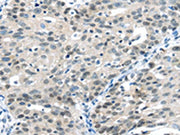 The image on the left is immunohistochemistry of paraffin-embedded Human breast cancer tissue using CSB-PA078687(CCNA1 Antibody) at dilution 1/20, on the right is treated with fusion protein. (Original magnification: ×200)