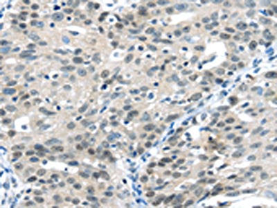 The image on the left is immunohistochemistry of paraffin-embedded Human breast cancer tissue using CSB-PA078687(CCNA1 Antibody) at dilution 1/20, on the right is treated with fusion protein. (Original magnification: ×200)