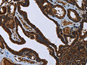 The image on the left is immunohistochemistry of paraffin-embedded Human thyroid cancer tissue using CSB-PA078717(FASTKD2 Antibody) at dilution 1/45, on the right is treated with fusion protein. (Original magnification: ×200)