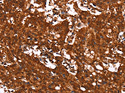 The image on the left is immunohistochemistry of paraffin-embedded Human gastic cancer tissue using CSB-PA078796(HCAR2 Antibody) at dilution 1/40, on the right is treated with synthetic peptide. (Original magnification: ×200)