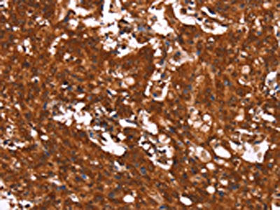The image on the left is immunohistochemistry of paraffin-embedded Human gastic cancer tissue using CSB-PA078796(HCAR2 Antibody) at dilution 1/40, on the right is treated with synthetic peptide. (Original magnification: ×200)
