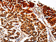 The image on the left is immunohistochemistry of paraffin-embedded Human lung cancer tissue using CSB-PA078927(AKR1B1 Antibody) at dilution 1/40, on the right is treated with fusion protein. (Original magnification: ×200)