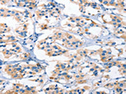 The image on the left is immunohistochemistry of paraffin-embedded Human thyroid cancer tissue using CSB-PA078954(AHR Antibody) at dilution 1/50, on the right is treated with synthetic peptide. (Original magnification: ×200)