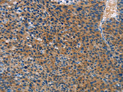 The image on the left is immunohistochemistry of paraffin-embedded Human liver cancer tissue using CSB-PA078977(STAMBP Antibody) at dilution 1/15, on the right is treated with fusion protein. (Original magnification: ×200)