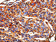 The image on the left is immunohistochemistry of paraffin-embedded Human liver cancer tissue using CSB-PA079344(ALB Antibody) at dilution 1/25, on the right is treated with fusion protein. (Original magnification: x200)