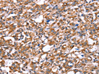 The image on the left is immunohistochemistry of paraffin-embedded Human thyroid cancer tissue using CSB-PA079476(GPC6 Antibody) at dilution 1/40, on the right is treated with synthetic peptide. (Original magnification: ×200)