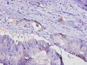 Immunohistochemistry of paraffin-embedded human colon cancer using CSB-PA07956A0Rb at dilution of 1:100