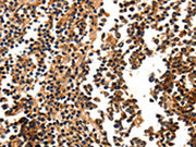 The image on the left is immunohistochemistry of paraffin-embedded Human tonsil tissue using CSB-PA079625(FOXB2 Antibody) at dilution 1/5, on the right is treated with synthetic peptide. (Original magnification: ×200)