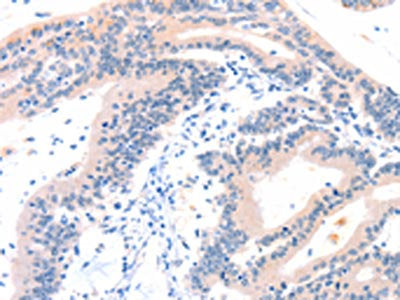 The image on the left is immunohistochemistry of paraffin-embedded Human colon cancer tissue using CSB-PA079709(ITGA6 Antibody) at dilution 1/50, on the right is treated with synthetic peptide. (Original magnification: ×200)