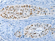 The image on the left is immunohistochemistry of paraffin-embedded Human cervical cancer tissue using CSB-PA079753(NEK4 Antibody) at dilution 1/20, on the right is treated with synthetic peptide. (Original magnification: ×200)