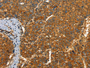 The image on the left is immunohistochemistry of paraffin-embedded Human liver cancer tissue using CSB-PA079894(PFKFB1 Antibody) at dilution 1/60, on the right is treated with synthetic peptide. (Original magnification: ×200)