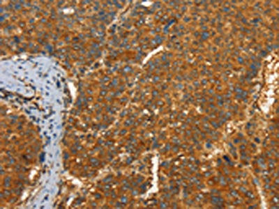 The image on the left is immunohistochemistry of paraffin-embedded Human liver cancer tissue using CSB-PA079894(PFKFB1 Antibody) at dilution 1/60, on the right is treated with synthetic peptide. (Original magnification: ×200)