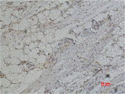 Immunohistochemical analysis of paraffin-embedded Human Heptocaricnoma using PRX I Polyclonal Antibody.