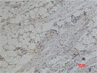 Immunohistochemical analysis of paraffin-embedded Human Heptocaricnoma using PRX I Polyclonal Antibody.