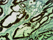 Immunohistochemical analysis of paraffin-embedded human Colon caricnoma using COX4 Polyclonal Antibody.