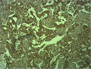 Immunohistochemical analysis of paraffin-embedded human Lung caricnoma using E-cadherin Polyclonal Antibody.
