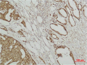 Immunohistochemical analysis of paraffin-embedded human Breast caricnoma using ERK 3 Polyclonal Antibody.