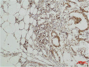 Immunohistochemical analysis of paraffin-embedded human Breast caricnoma using ERK 5 Polyclonal Antibody.