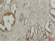 Immunohistochemical analysis of paraffin-embedded human Breast caricnoma using ERK 5 Polyclonal Antibody.
