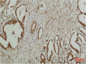Immunohistochemical analysis of paraffin-embedded human Breast caricnoma using ERK 5 Polyclonal Antibody.