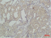 Immunohistochemical analysis of paraffin-embedded human Breast caricnoma using SLUG Polyclonal Antibody.