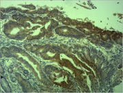 Immunohistochemical analysis of paraffin-embedded human Colon caricnoma using Survivin Polyclonal Antibody.