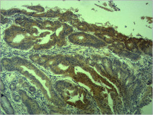 Immunohistochemical analysis of paraffin-embedded human Colon caricnoma using Survivin Polyclonal Antibody.
