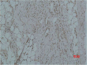 Immunohistochemical analysis of paraffin-embedded Human Hepatocarcinoma using CALHM1 Polyclonal Antibody.
