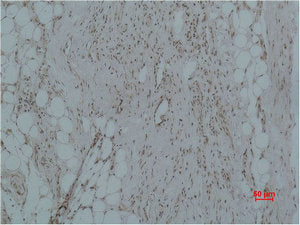Immunohistochemical analysis of paraffin-embedded Human Hepatocarcinoma using CALHM1 Polyclonal Antibody.