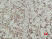 Immunohistochemical analysis of paraffin-embedded human Breast caricnoma using Histone H3 Polyclonal Antibody.