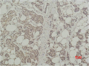 Immunohistochemical analysis of paraffin-embedded human Breast caricnoma using Histone H3 Polyclonal Antibody.