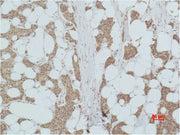 Immunohistochemical analysis of paraffin-embedded human Breast caricnoma using PI 3-kinase p85α Polyclonal Antibody.