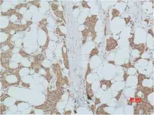 Immunohistochemical analysis of paraffin-embedded human Breast caricnoma using PI 3-kinase p85α Polyclonal Antibody.