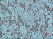 Immunohistochemical analysis of paraffin-embedded human Breast caricnoma using Smad3 Polyclonal Antibody.